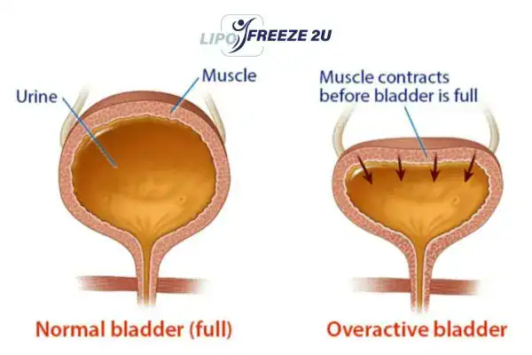diagram of overactive bladder treatment Brentwood