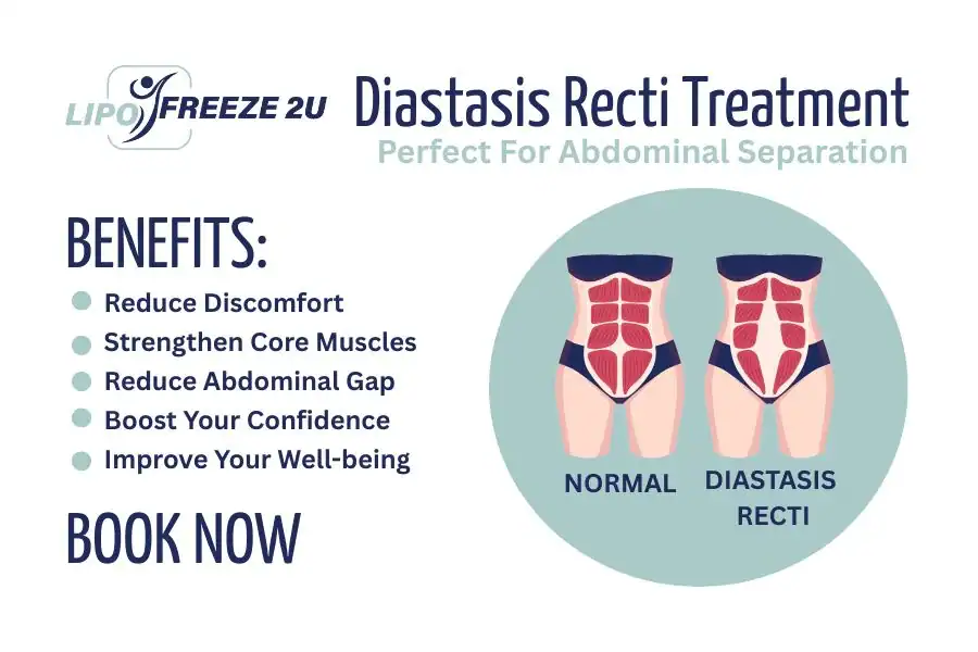 Benefits of body toning treatment Brentwood for Diastasis recti