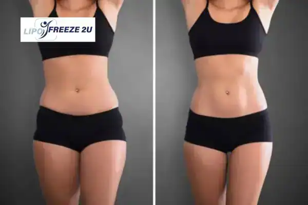 How Can LIPO FREEZE 2U Support Your Post-Pregnancy Body Recovery Brentwood?