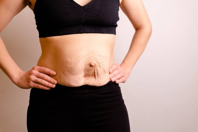 Is Surgery Really the Only Way to Repair Diastasis Recti Brentwood?