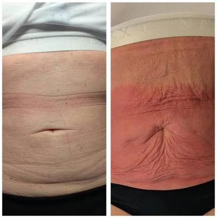 How Does RF Microneedling Improve Crepey, Thin and Uneven Skin Texture Brentwood?