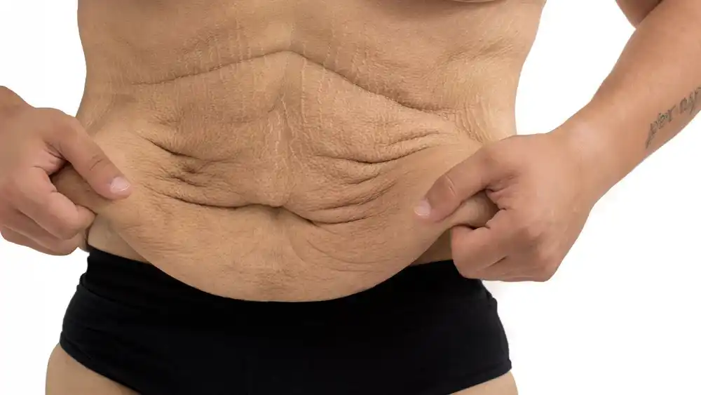 RF Microneedling for Loose Skin: How Can It Help Tighten and Reshape the Skin Brentwood?